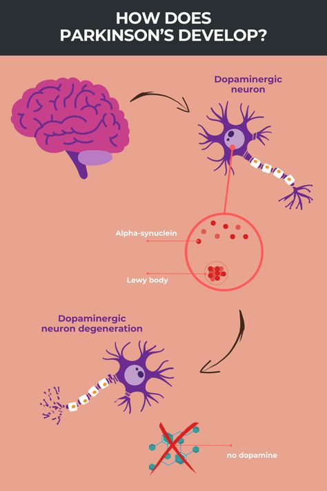 What is Parkinson’s disease? | Parkinson's News Today Parkinson Disease, Parkinsons Awareness, Nurse Notes, Lewy Body, Nerve Cell, Neurological Disorders, Sleep Problems, Pharmacology, Healing Process