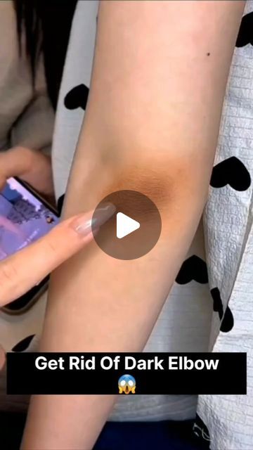 78K views · 1.6K likes | Pihu officials on Instagram: "Get Rid Of Dark Elbow/Dark Elbow Whitening Tips 

.
.
.
.
.
#darkelbows #darkelbowwhitening #ridofdarkelbow #elbow #skincareroutine #skincare #trending #instagood #viral #instagram" Dark Elbows Remedies, Dark Elbows How To Get Rid Of, Elbow Whitening, Dry Elbows, Dark Elbows, Dark Armpits, Viral Song, Lemon Honey, Dark Underarms