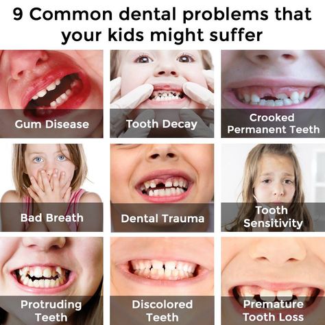 These are the 9 common dental problems that your kids might suffer from. Sedation Dentistry, Kids Teeth, Pediatric Dental, Restorative Dentistry, Dental Kids, Pediatric Dentist, Pediatric Dentistry, Dental Problems, Oral Health Care