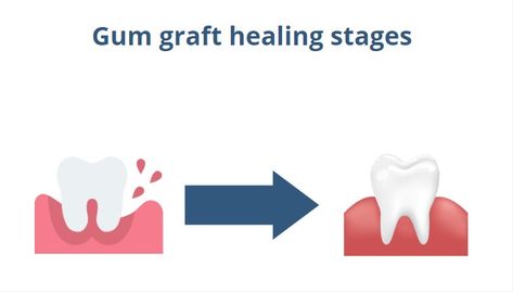 Explore the different stages of healing with a gum graft and learn how to properly care for your gums post-surgery. From initial recovery to full healing, we've got you covered. #gumgraft #dentalhealth #oralcare Stages Of Healing, Gum Graft, Day Pictures, Post Surgery, Day By Day, Healing Process, Dental Health, Oral Care, Surgery