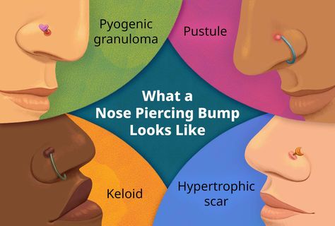 Piercing Ideas Nose Stud, How To Get Rid Of Nose Piercing Bump, How To Get Rid Of Piercing Bumps Fast, Nose Piercing Diy, Piercing Bump Remedy, Right Nose Piercing, Nose Ring Bump, Nose Piercing Healing, Nose Piercing Bump