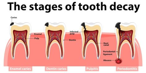 Free vector infographic of human in the ... | Free Vector #Freepik #freevector #periodontitis #people-clipart #cartoon-drawing #tooth-decay People Clipart, People Drawing, Vector Infographic, Dental Office Design, Patient Education, Clipart Cartoon, Cartoon Drawing, Dental Office, Tooth Decay