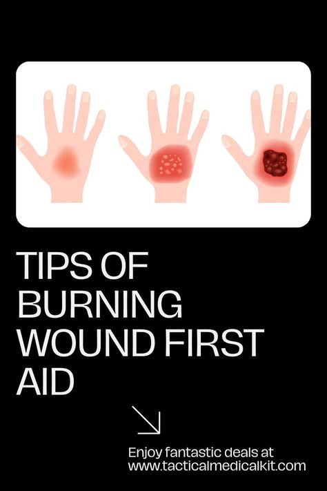 Tips of burning wound first aid, with the tips, no matter the degree of the burn, you can help a victim ease their pain and even save their lives before they get a chance to receive professional attention. Types Of Burns, First Aid For Burns, 2nd Degree Burns, Degree Burns, Math Quotes, Skin Layers, Child Life, First Aid, Nerve