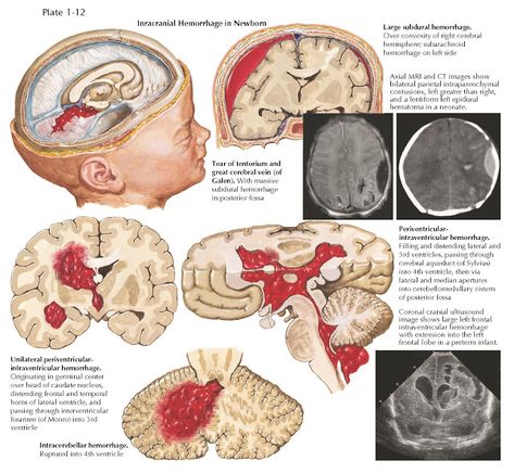 Intracranial Hemorrhage, Subarachnoid Hemorrhage, Intracranial Pressure, Mri Scan, Neurology, Radiology, Nervous System, The Field, Brain