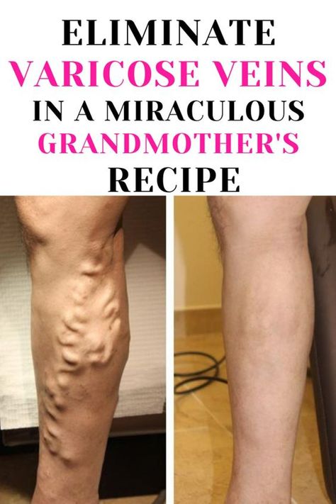 Get rid of varicose veins with a natural recipe that’s easy to make at home. Follow these eight simple steps and enjoy healthier, more beautiful legs. Ingredients: Instructions : Note : The preparation time for this recipe is about 15 minutes. However, you will need to leave the paste on for 30 minutes, so be […] Vericous Veins, Varicose Veins Exercises, Varicose Veins Essential Oils, Varicose Vein Remedy, Vein Removal, Leg Veins, Natural Beauty Tips, Natural Treatments, Home Remedies