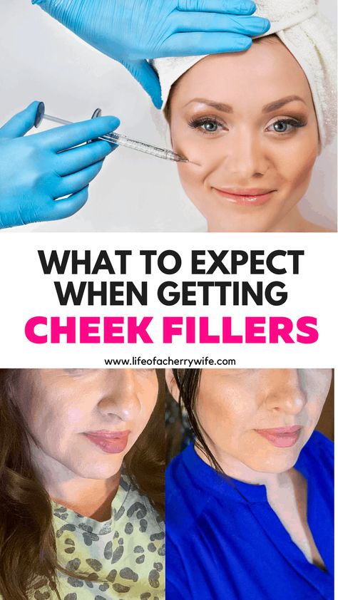 Check Filler Before And After, Filler In Cheeks Before And After, Before And After Cheek Filler, Face Fillers Before And After Cheeks, Midface Cheek Filler, Cheek Filler Before And After, Botox And Fillers Before After, Facial Fillers Before And After, Cheekbone Filler Before And After