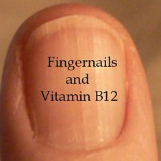 Low Vitamin B12, Fingernail Health, Nail Ridges, Health Signs, Natural Healing Remedies, Nail Health, Vitamin B12, Natural Health Remedies, Health Info