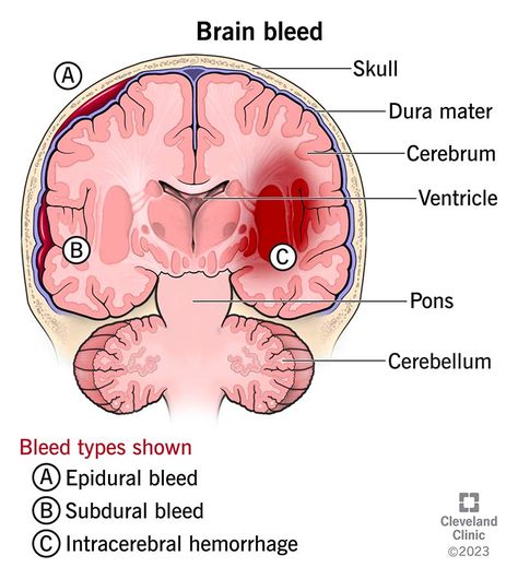 Brain Bleed: When To Call for Help Brain Bleed, Intracranial Hemorrhage, Nurse Skills, Subarachnoid Hemorrhage, Types Of Strokes, Neurological System, Medical Study, Arteries And Veins, Family Nurse Practitioner