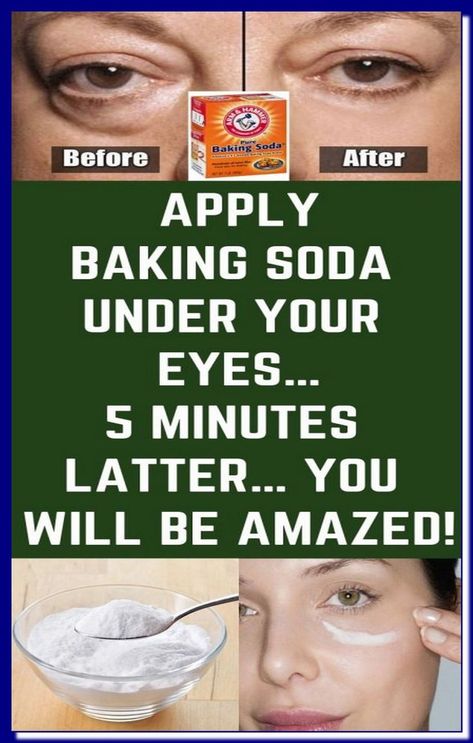 APPLY BAKING SODA UNDER YOUR EYES� 5 MINUTES LATTER� YOU WILL BE AMAZED! Baking Soda Face Mask, Baking Soda Face, Baking Soda Benefits, Natural Mask, Baking Soda Uses, Baking Soda Shampoo, Oil Free Moisturizers, Homemade Face Masks, Homemade Face