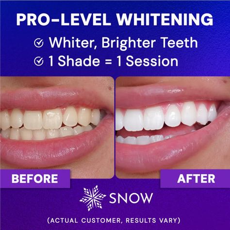 SNOW | Best Teeth Whitening Kits, Strips, Toothpaste & More Snow Teeth Whitening, Diamond Teeth, Best Teeth Whitening, Stained Teeth, Whitening Kit, Teeth Whitening Kit, Whitening Toothpaste, Sensitive Teeth, Mouthwash