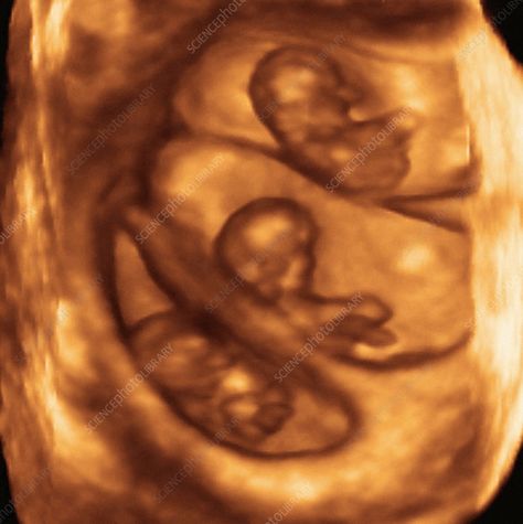 3d Ultrasound Pictures, 3d Ultrasound, 4d Ultrasound, Baby Ultrasound, Triplet Babies, Ultrasound Pictures, Baby Scan, Science Photos, Cute Stories