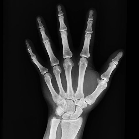 So, your blood work has come in and you are not getting enough calcium. This can be dangerous the older you get, as brittle bones can easily break and take a long time to heal. Here are some practical steps you can take to make sure your bones stay h... Xray Art, Sepia Art, Bone Loss, Bone Density, Human Hand, Hand Tattoo, Bone Health, Radiology, What’s Going On