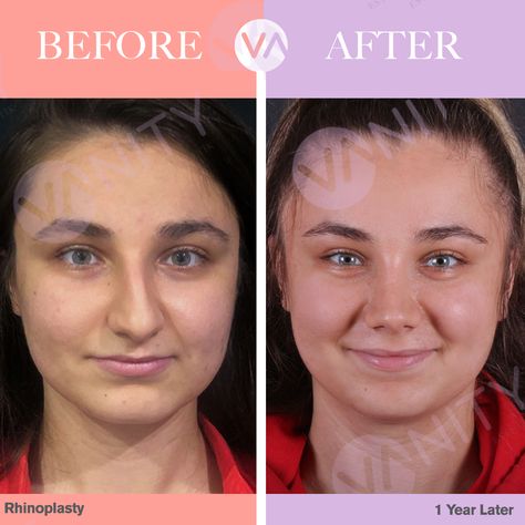 Nose Fillers, Crooked Nose, Rhinoplasty Nose Jobs, Rhinoplasty Before And After, Nose Surgery, Nose Work, Nose Job, Lip Fillers, Cosmetic Surgery