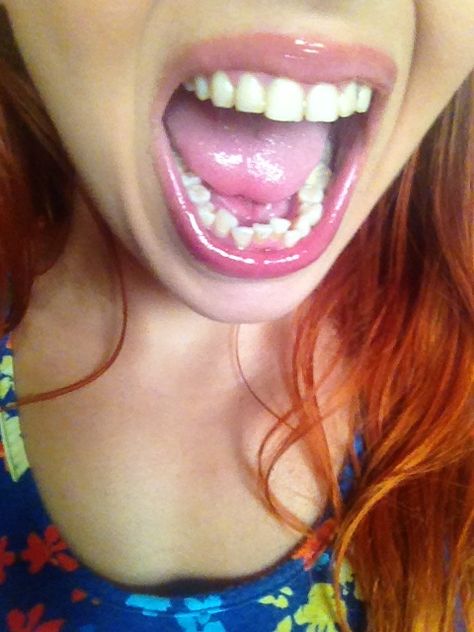 "I would never wear traditional braces again. First of all, they are just plain ugly, and secondly, I’m an adult," says Cailin, a beauty blogger from SassyDove.com. Find out why she's considering Invsalign to straighten her crooked bottom teeth. Crooked Teeth Aesthetic, Bottom Teeth Braces, Bottom Braces, Braces Colors Ideas, Teeth Aesthetic, Braces Cost, Bottom Teeth, Traditional Braces, Health Aesthetic