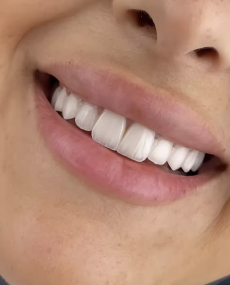 Bunny Teeth Aesthetic, Straight Teeth Aesthetic, Bunny Teeth Smile, White Straight Teeth, Perfect Teeth Aesthetic, Whitened Teeth, White Teeth Aesthetic, Perfect Teeth Smile, Smile Tips