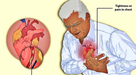 Heart Arteries, Acute Coronary Syndrome, Cardiac Disease, Chest Discomfort, Angina Pectoris, High Cholesterol Levels, Clogged Arteries, Heart Muscle, Coronary Arteries