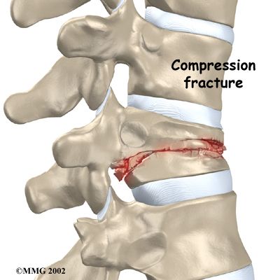 Symptoms of a Spinal Compression Fracture http://www.webmd.com/osteoporosis/guide/spinal-compression-fractures-symptoms Spine Bone, Fracture Healing, Chiropractic Therapy, Radiology Student, Spine Care, Severe Back Pain, Medical Transcription, Spinal Injury, Guided Visualization