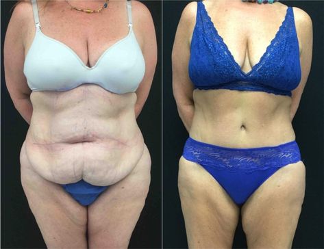 Tummy Tuck | Before And After | Abdominoplasty | Fairfax Panniculectomy Before And After, Tummy Tucks Recovery, Healing Symbols, Daily Workouts, Mommy Makeover, Im A Barbie Girl, Cosmetic Procedures, Tummy Tucks, After Photos