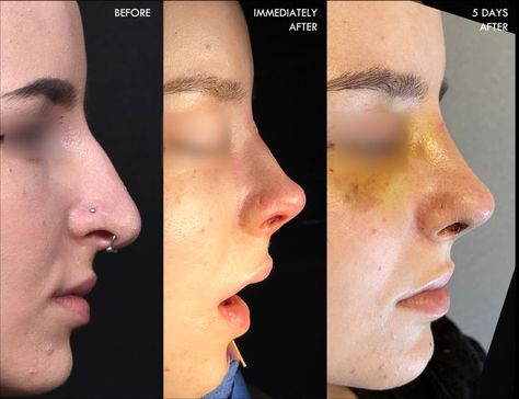 Rhinoplasty recovery can be a source of worry for a lot of our patients, but modern techniques and preservation rhinoplasty approaches can make recovery surprisingly smooth. This young patient is shown before, immediately after, and 5 days after nose surgery. She has moderate swelling. Her bruising is limited. She has been off pain medications for 2 days and reports "breathing better than I have ever breathed before." Rhinoplasty Recovery, Nose Surgery, Surgery Recovery, Atlanta Ga, Plastic Surgery, Surgery, Ear Cuff, Atlanta, Nose Ring