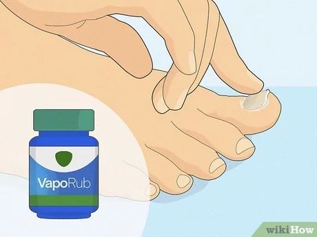 foot nail fungus remedies Foot Fungus Remedies How To Get Rid Of, Fungal Toenail Remedies, Toe Nail Fungus Home Remedy, How To Get Rid Of Toenail Fungus Fast, How To Get Rid Of Toenail Fungus, Nail Fungal Infection Toenails, Thick Toenail Remedy How To Get Rid, How To Get Rid Of Fungal Toenails, Athletes Foot Remedy How To Get Rid Of