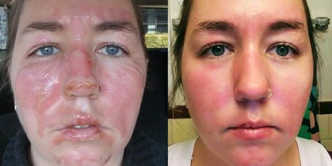 Woman Photos Show the Healing Process of Second-Degree Burns Second Degree Burn, Chemical Burn, Side By Side Photo, Work Accident, Woman Photos, Healing Abilities, Degree Burns, The Healing Process, Makeup School