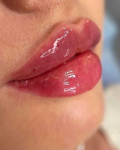 Dermal Fillers Lips, Ethnic Rhinoplasty, Lips Inspiration, Wax Roller, Botox Lips, Lip Augmentation, Vision Board Photos, Facial Aesthetics, Nice Lips