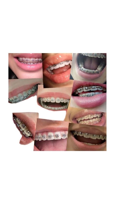 Braces On Crooked Teeth, Braces Color Combos, Cute Braces Colors, Pretty Teeth, Braces Tips, Getting Braces, Cute Braces, Crooked Teeth, Braces Colors