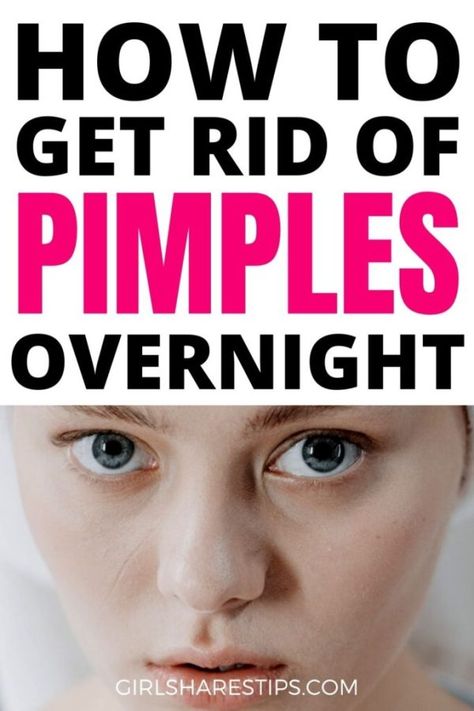 Clear Skin Tips Pimples, Clear Skin Tips Dark Spots, Overnight Clear Skin, Skin Tips For Oily Skin, How To Hide Pimples, Clear Skin At Home, Clear Skin In A Week, Get Clear Skin Fast, Skincare Routine Clear Skin