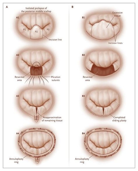 Mitral Valve Regurgitation, Heart Facts, Heart Valve, Diagnostic Medical Sonography, Mitral Valve, Heart Surgeon, Chest Discomfort, Heart Valves, Medical Pictures