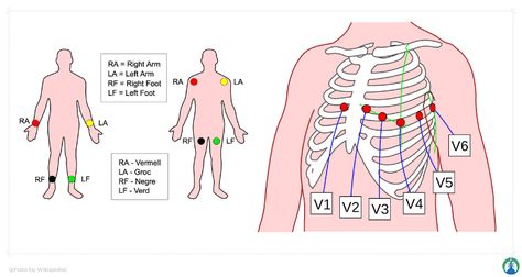 Ekg Lead Placement Cheat Sheets, Ekg Placement, Ekg Leads, Respiratory Therapist Student, Ekg Tech, Ekg Technician, Ekg Rhythms, Er Tech, Nursing Work