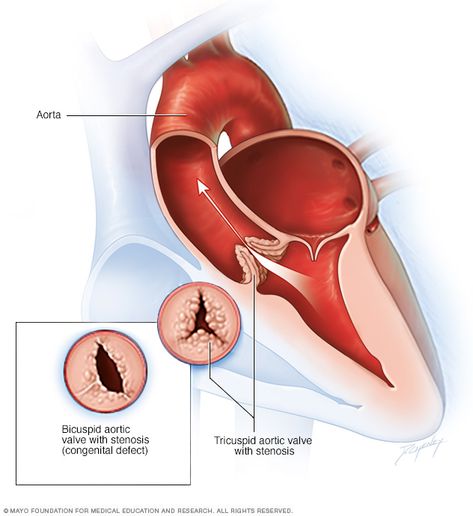 Aortic valve stenosis Aortic Valve Stenosis, Bicuspid Aortic Valve, Cardiac Sonography, Aortic Valve Replacement, Heart Valves, Open Heart Surgery, Disease Symptoms, Heart Conditions, Heart Surgery