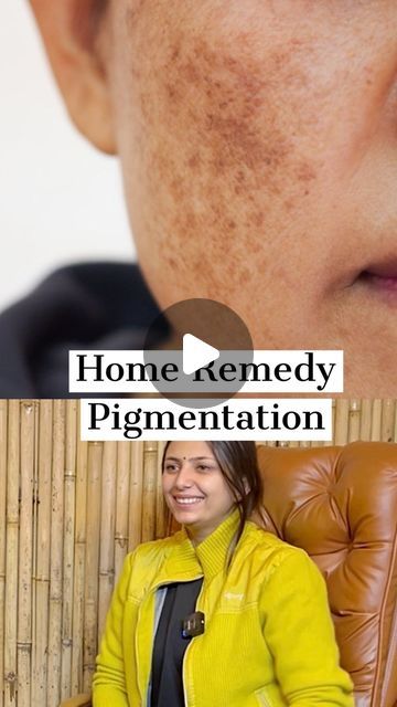 Himanshu Bhatt on Instagram: "Pigmentation Home Remedy   #pigmentation #skincare #beauty #himanshubhatt" Pigmentation Removal Remedies, Pigmentation On Face Remedies, Remedies For Pigmentation On Face, How To Reduce Pigmentation On Face, Face Pigmentation Remedies, Acv For Skin, Pigmentation On Face, Pigmentation Skincare, Pigmentation Remedy