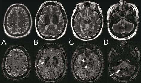 Basal Ganglia, Cognitive Impairment, Hemoglobin Levels, Late 30s, Cerebrospinal Fluid, Healthy Man, Phlebotomy, Central Nervous System, Medical Records