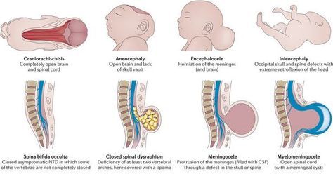 Neural Tube Defects - www.PamelaEgan.com Obstetric Ultrasound, Ultrasound Sonography, Diagnostic Medical Sonography, Ultrasound Technician, Spina Bifida, Ultrasound Tech, Nursing School Survival, Fetal Development, Nursing School Notes