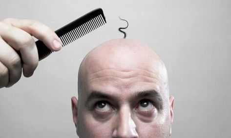 Causes Of Hair Fall, Female Pattern Baldness, Going Bald, Male Pattern Baldness, Pattern Baldness, Bald Hair, Hair Control, Lost Hair, Hair Thickening