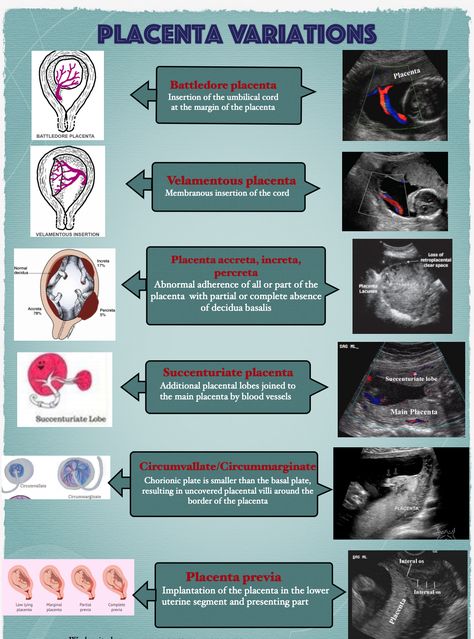 placenta  ultrasound Ultrasound Notes Study, Sonography Notes Ultrasound, Ultrasound Technician Aesthetic Notes, Diagnostic Medical Sonography Student Notes, Ultrasound Technician Notes, Sonography Student Notes, Sonography Student Study Obgyn, Ultrasound Tech Study Notes, Black Ultrasound Technician