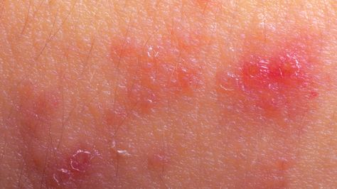 Rash On Stomach, Skin Rash Remedies, Heat Rash Remedy, Skin Rashes Pictures, Rash On Hands, Leg Rash, Common Skin Rashes, Shingles Rash, Allergy Rash