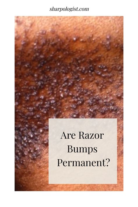 Are Razor Bumps Permanent - Sharpologist Razor Bumps Remedy, Get Rid Of Ingrown Hairs, Best Permanent Hair Removal, Razor Bump, Treat Ingrown Hair, Shaving Bumps, Soothing Face Mask, Bump Hairstyles, Shaving Tips