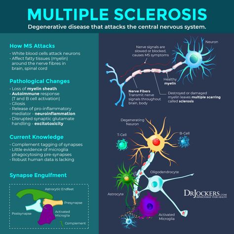 Multiple Sclerosis: Causes, Symptoms & Natural Support Strategies Ms Symptoms Natural Remedies, Multiple Sclerosis Diet, Multiple Sclerosis Quotes, Dr Jockers, Multiple Sclerosis Awareness Month, Ms Exercises, Medicine Art, Multiple Sclerosis Symptoms, Brain Disorders