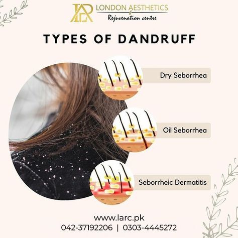 Suffering from chronic dandruff? No Worries! Stop stressing and start recovering with our vast range of treatments for all the 3 types of chronic dandruff: ✔️ Seborrheic Dermatitis A severe form of oily skin dandruff. Your scalp feels as if it's on fire! ✔️ Oily Skin Dandruff When the surface of your scalp and hair is greasy and oily with an unpleasant odour. ✔️ Dry Skin Dandruff This is when the surface of your scalp and hair is dry and flaky and the skin is red and itchy. Stop Stressing, Oily Scalp, Itchy Scalp, Dandruff, On Fire, Dry Hair, Oily Skin, The 3, Dry Skin