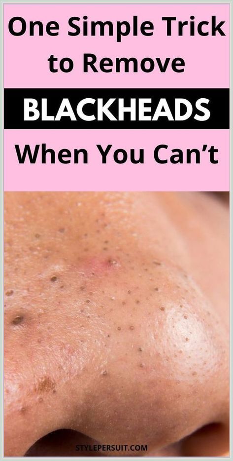 Get Rid of Blackheads For Good Remove Blackheads From Nose, Blind Pimple, Blackhead Remedies, Blackheads On Nose, Rid Of Blackheads, Black Heads, Blackheads Removal, Cold Sores Remedies, Remove Blackheads