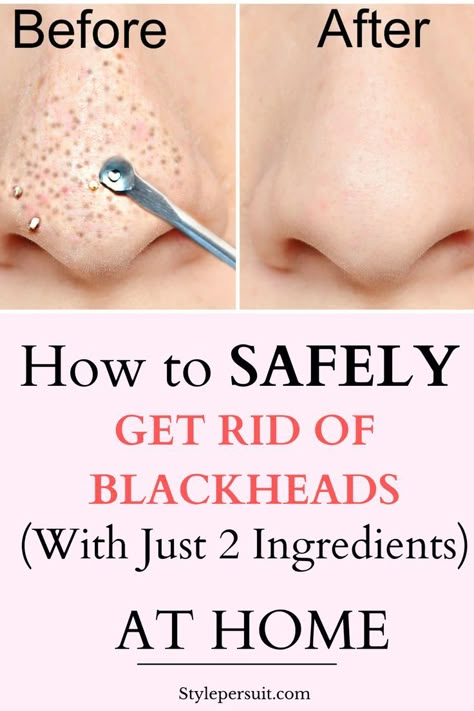 You can easily get rid of these blackheads by using natural or home remedies for blackhead treatment. Click to read How to get rid of blackheads diy| The best blackheads removal on nose| get rid of blackhads on face| get rid of blackheads on nose| how to get rid of blackheads naturally ... What Are Blackheads, Clean Clear Skin, Get Rid Of Pores, Clear Smooth Skin, Remove Blackheads From Nose, Blackheads On Face, Green Tea Face Mask, Blackhead Remover Diy, Control Oily Skin