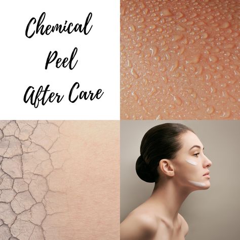 After Chemical Peel Care, Chemical Peel Aftercare, Chemical Peel Benefits, Peels For Face, Really Bad Sunburn, Chemical Face Peel, Aesthetics Business, Sunburn Peeling, Bad Sunburn