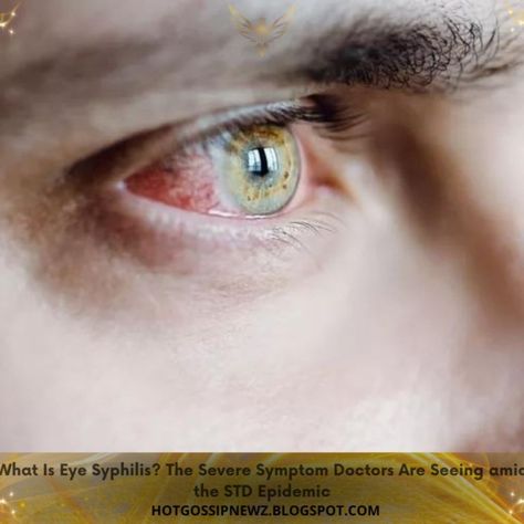 What Is Eye Syphilis? The Severe Symptom Doctors Are Seeing amid the STD Epidemic Disease, Health