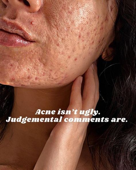 Acne Photos, Girl With Acne, Forehead Acne, Natural Acne Remedies, How To Get Rid Of Pimples, Pimple Marks, Face Acne, Acne Remedies, Acne Marks