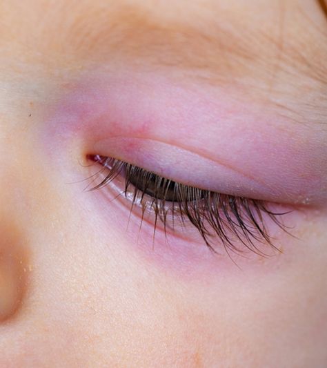 Swollen Eye Remedies, Newborn Baby Eyes, Stye Remedy, Swollen Eyelid, Allergy Eyes, Swollen Face, Swollen Eyes, Natural Remedies For Migraines, Back Stretches For Pain