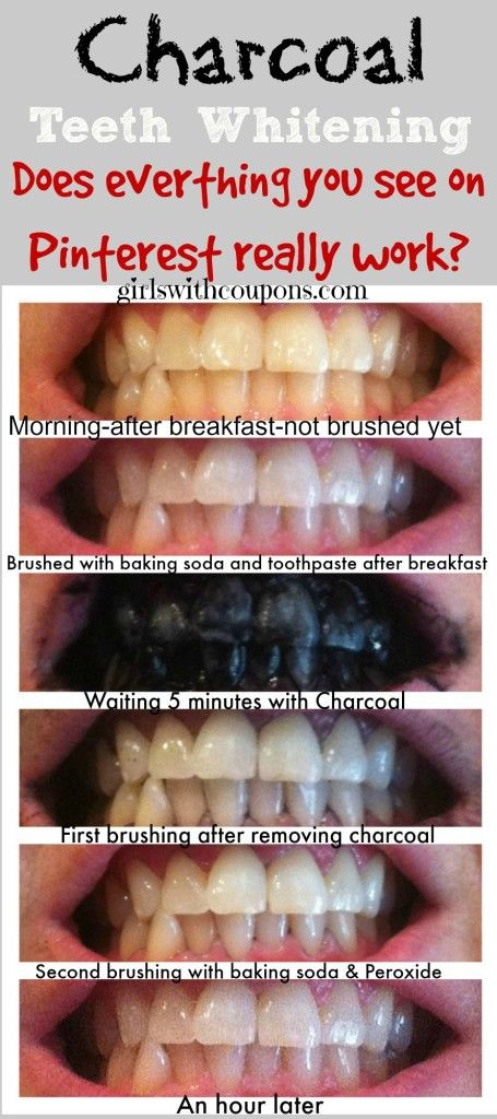 Apply one or more of these incredible homemade teeth whitening solutions onto your teeth and get the shining smile of your dreams! Brushing With Baking Soda, Baking Soda Toothpaste, Lung Cleanse, Teeth Whitening Homemade, Skin Moles, Charcoal Toothpaste, Teeth Whitening Remedies, Teeth Whitening Diy, Charcoal Teeth Whitening