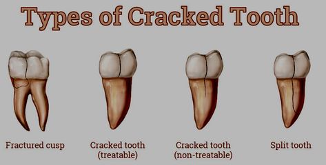 Cracked Tooth Syndrome | Lorne Park Dental | Mississauga Dentist Fca Ideas, Tooth Nerve, Cracked Tooth, Tooth Filling, Molar Tooth, Dental Fillings, Tooth Enamel, Dental Veneers, Tooth Pain