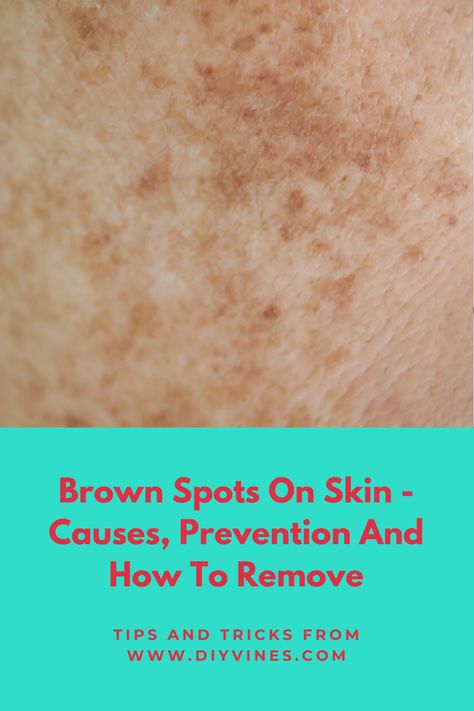 Spots On Skin, Dry Oily Skin, Under Eye Circles, Brown Spots On Skin, Lotion For Oily Skin, Spots On Legs, Top Anti Aging Products, Tips For Oily Skin, Oily Skin Acne