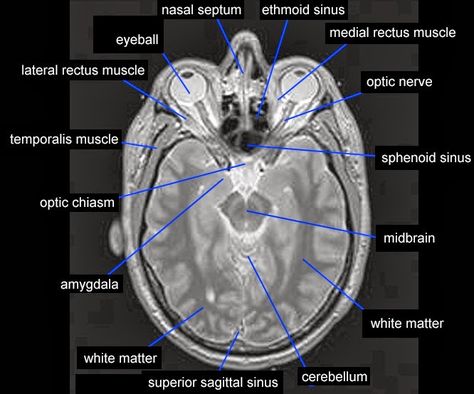 MRI temporalis muscle anatomy | Radiology Anatomy Images Mri Study Guide, Temporalis Muscle, Mri Anatomy, Radiology Anatomy, Medical Radiography, Radiology Humor, Mri Brain, Radiology Student, Anatomy Images